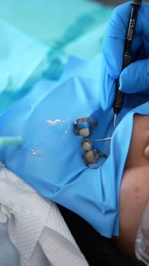 Dental Procedure Close-Up Stock Footage 311937335