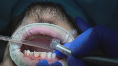 Dental Procedure Close-Up Stock Footage 316913533