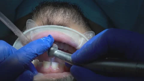 Dental Procedure Close-Up Stock Footage 316913596