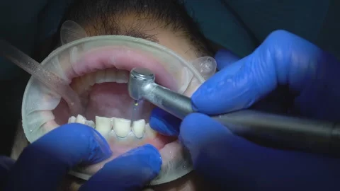 Dental Procedure Close-Up Stock Footage 316913907