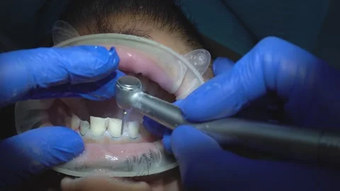 Dental Procedure Close-Up Stock Footage 316913934