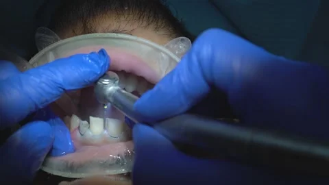 Dental Procedure Close-Up Stock Footage 316913993
