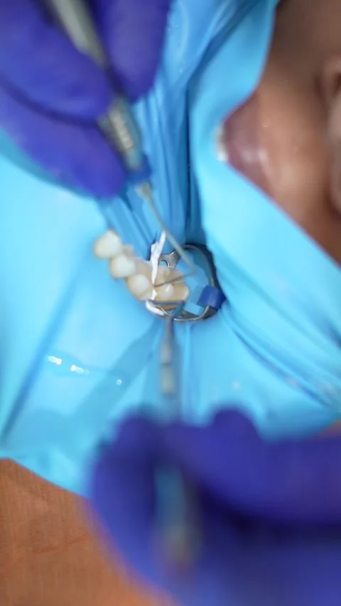 Dental Procedure Close-Up Stock Footage 316914498