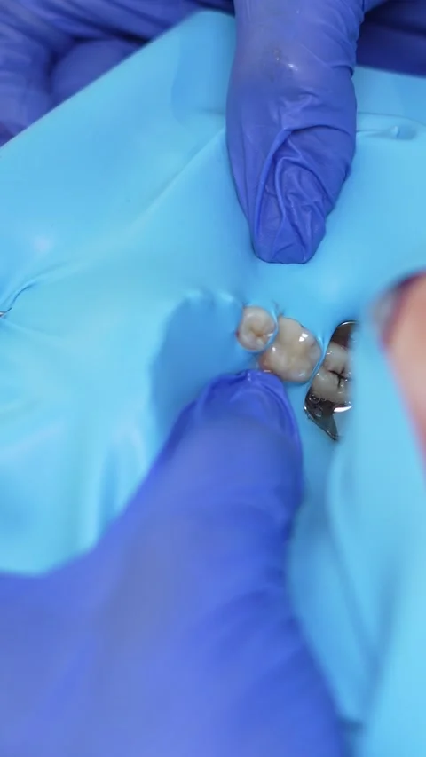 Dental Procedure Close-Up Stock Footage 316914640