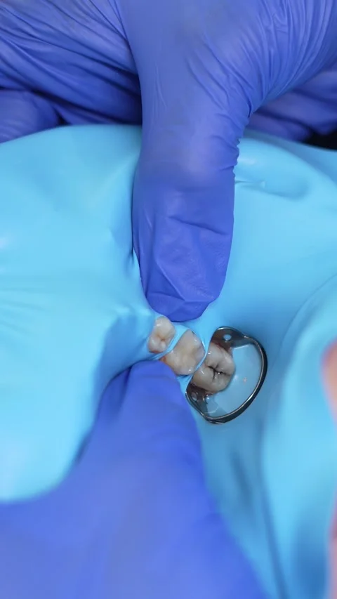 Dental Procedure Close-Up Stock Footage 316914672