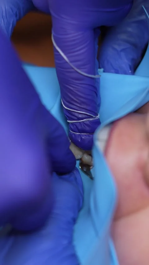 Dental Procedure Close-Up Stock Footage 316914703