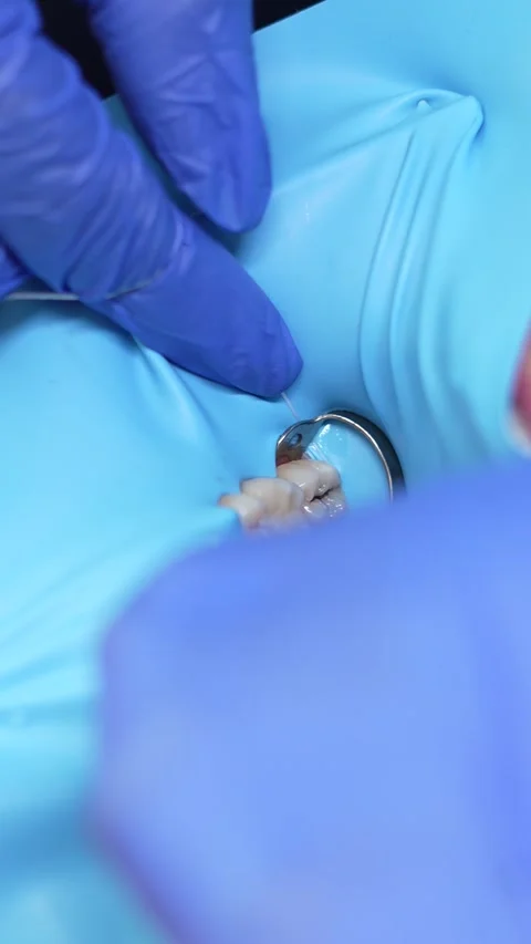 Dental Procedure Close-Up Stock Footage 316914824
