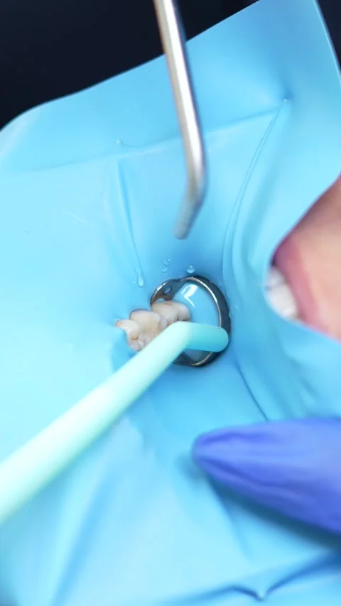 Dental Procedure Close-Up Video stock 316914855