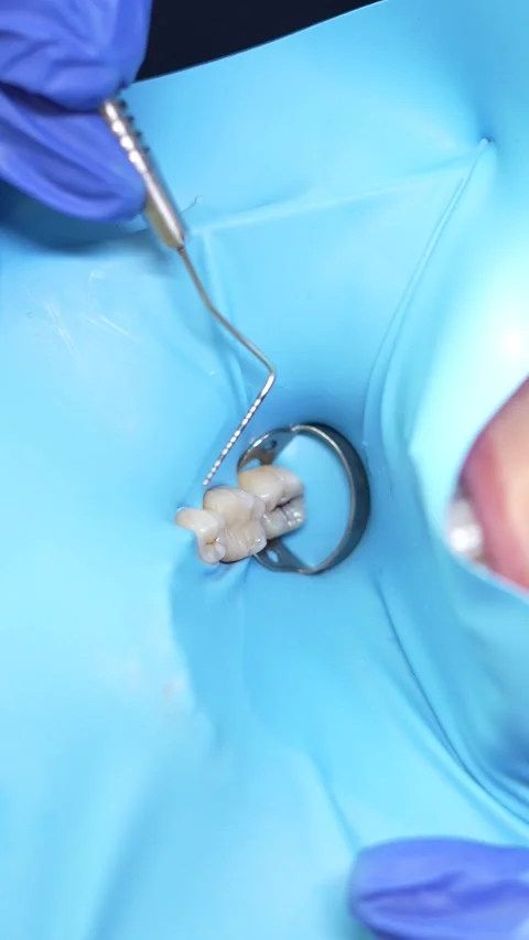 Dental Procedure Close-Up Stock Footage 316914875