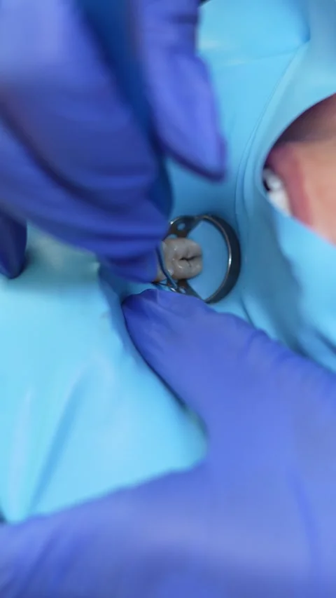 Dental Procedure Close-Up Stock Footage 316914897