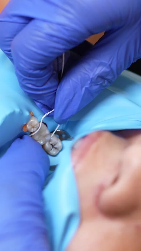 Dental Procedure Close-Up Stock Footage 316915183