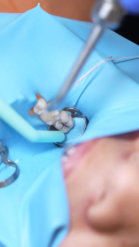 Dental Procedure Close-Up Stock Footage 316915271