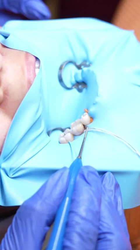 Dental Procedure Close-Up Video stock 316915288