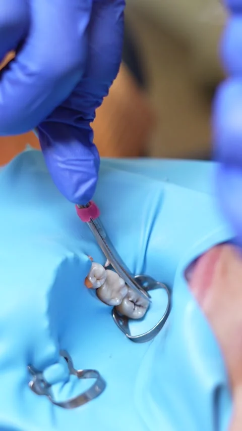Dental Procedure Close-Up Stock Footage 316915304