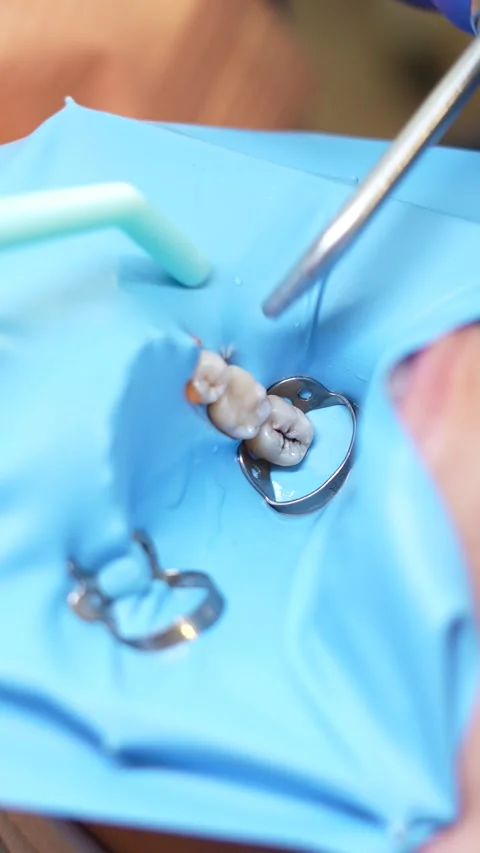 Dental Procedure Close-Up Stock Footage 316915440