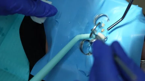 Dental Procedure Close-Up Stock Footage 316916293