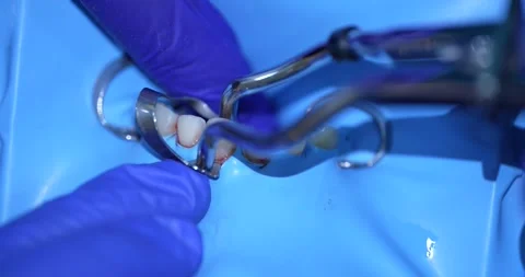Dental Procedure Close-up Stock Footage 316916945