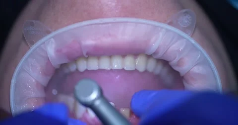 Dental Procedure Close-Up Stock Footage 316917096
