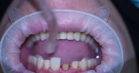 Dental Procedure Close-Up Video stock 316917201