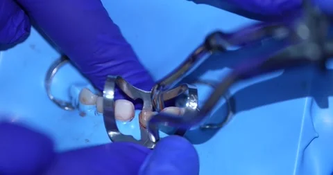 Dental Procedure Close-Up Video stock 316917326