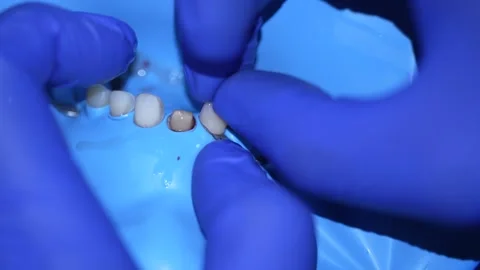 Dental Procedure Close-Up Stock Footage 316917366