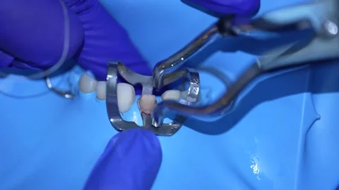 Dental Procedure Close-Up Stock Footage 316917370