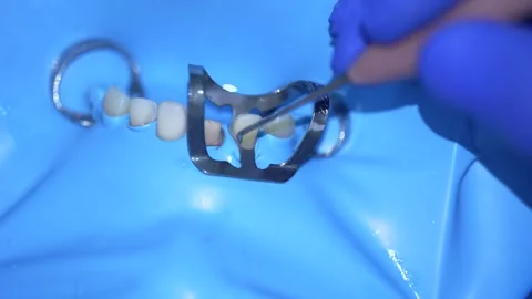 Dental Procedure Close-Up Stock Footage 316917374