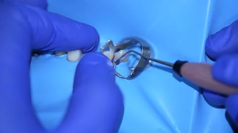 Dental Procedure Close-Up Stock Footage 316917392
