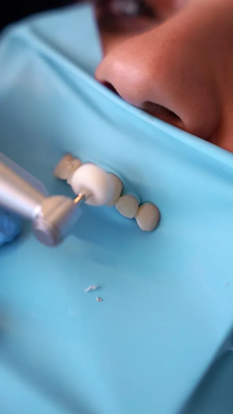 Dental Procedure Close-up Stock Footage 331163630