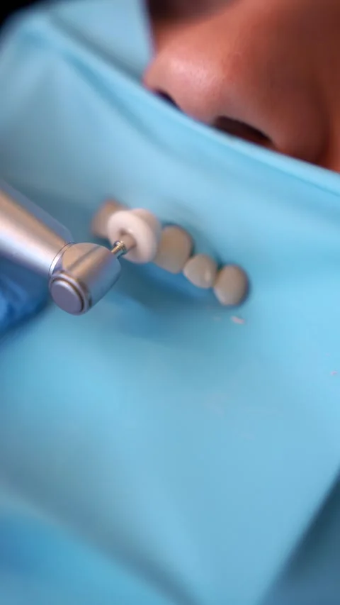 Dental Procedure Close-Up Stock Footage 331163903