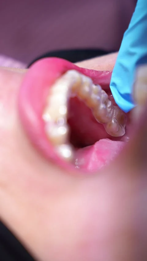 Dental Procedure Close-Up Stock Footage 331164121