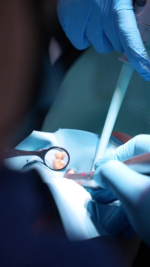 Dental Procedure Close-Up Stock Footage 331164168