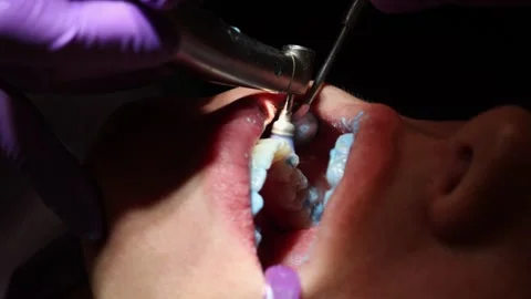Dental Procedure Close-Up with Impression Material Stock Footage 312630135