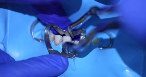 Dental Procedure Demonstration Stock Footage 316916837