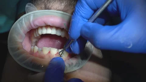 Dental Procedure Stock Footage 316913827