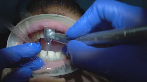 Dental Procedure Stock Footage 316913960