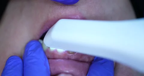Dental Procedure Observation Stock Footage 316917179