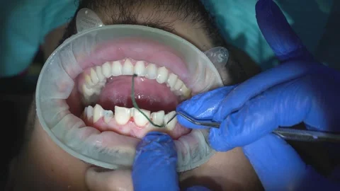 Dental Procedure Overview Stock Footage 316913817