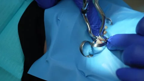 Dental Procedure Overview Stock Footage 316914329