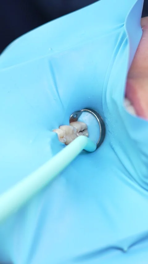 Dental Procedure Overview Video stock 316914798