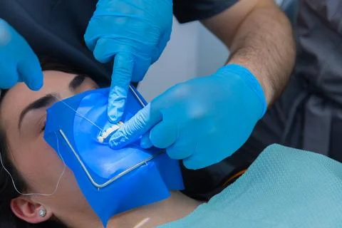 Dental Procedure in Progress: Close-Up of Dentists Hands Applying Dental Element Stock Photos