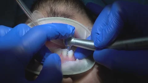 Dental Procedure in Progress Stock Footage 316913348