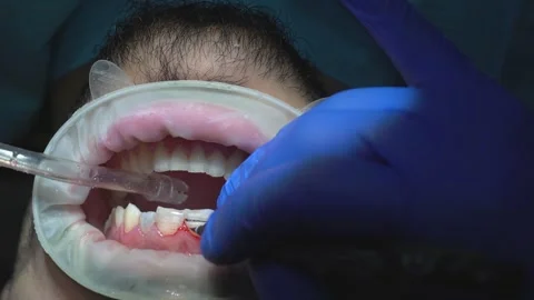Dental Procedure in Progress Stock Footage 316913396