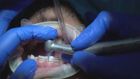 Dental Procedure in Progress Stock Footage 316913416