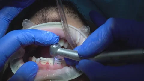 Dental Procedure in Progress Stock Footage 316913446