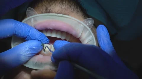 Dental Procedure in Progress Stock Footage 316913814