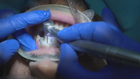 Dental Procedure in Progress Stock Footage 316913981