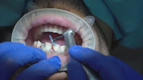 Dental Procedure in Progress Stock Footage 316914127