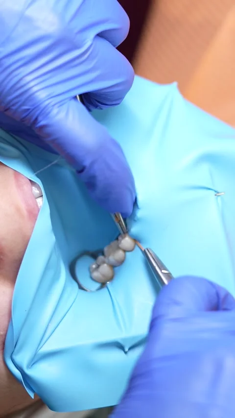 Dental Procedure in Progress Stock Footage 316914941