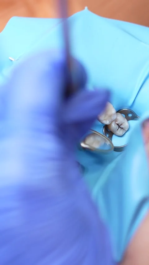 Dental Procedure in Progress Stock Footage 316915018